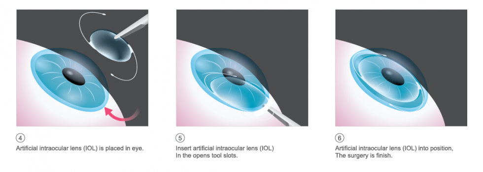 Cataract Surgery - Lakeside Vision Center